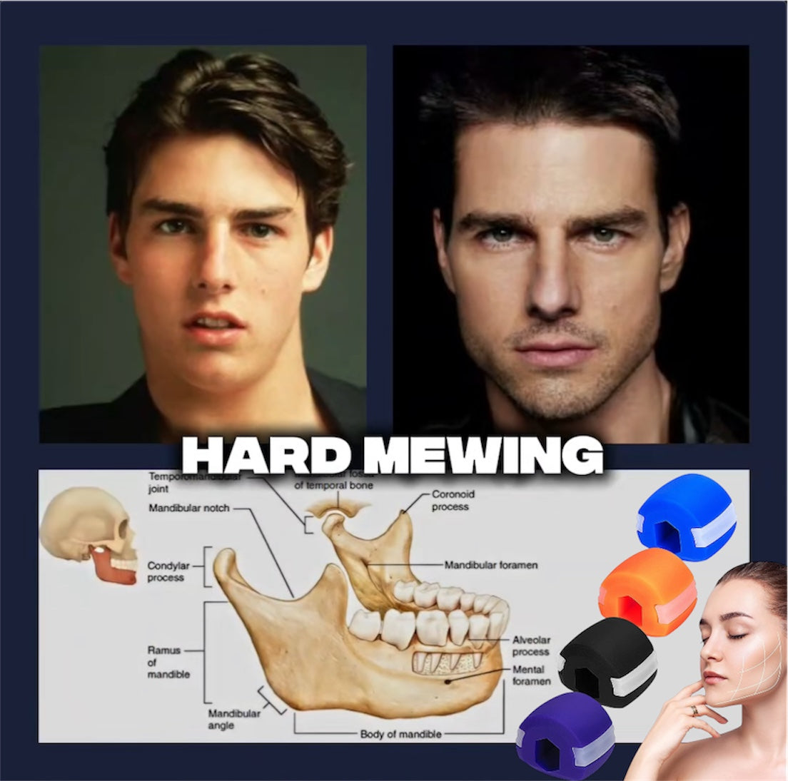 Jawflex™ - Jaw, Face, and Neck Exerciser